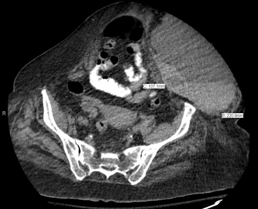 Hematoma