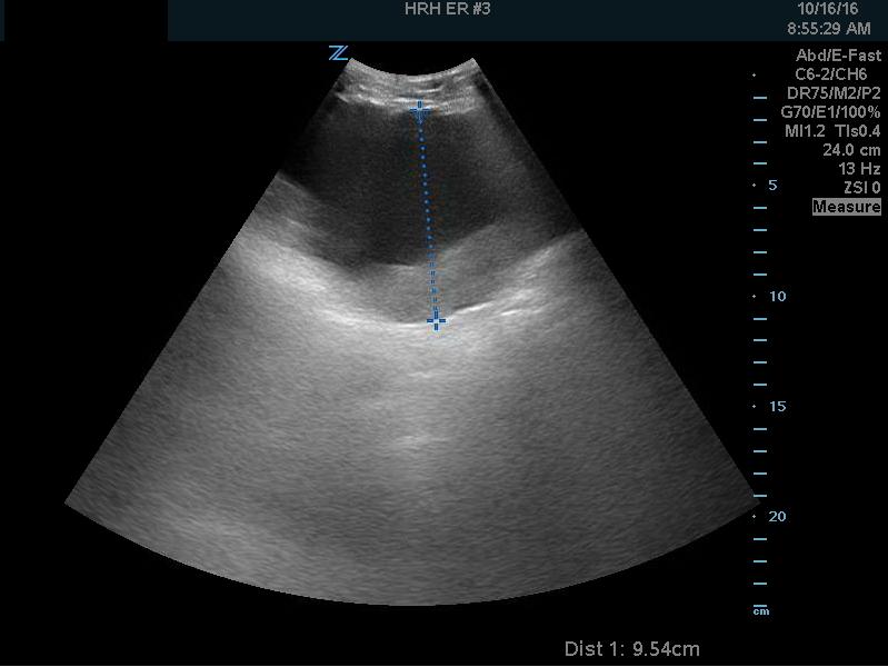 Hematoma1