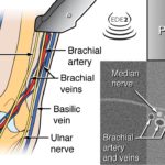 Rhein Man and POCUS-guided IVs